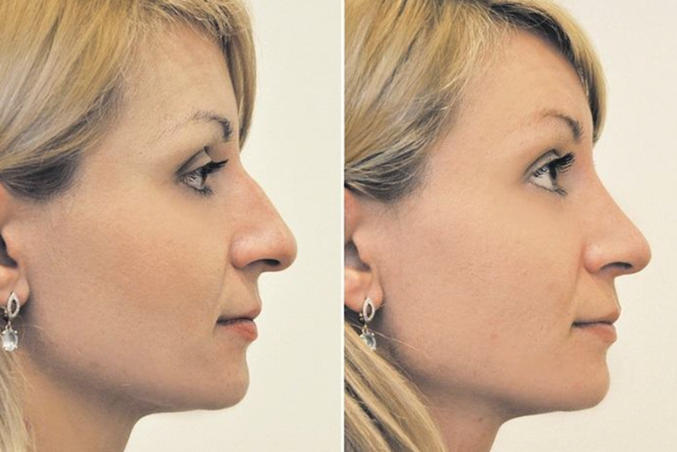 Фото ринопластики до и после нос. Инъекционная ринопластика. Пластика носа. Пластика кончика носа. Безоперационная ринопластика.